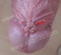 阴茎系带尖锐湿疣症状图片
